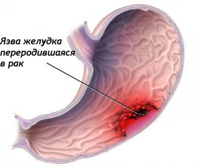 Типы рака желудка