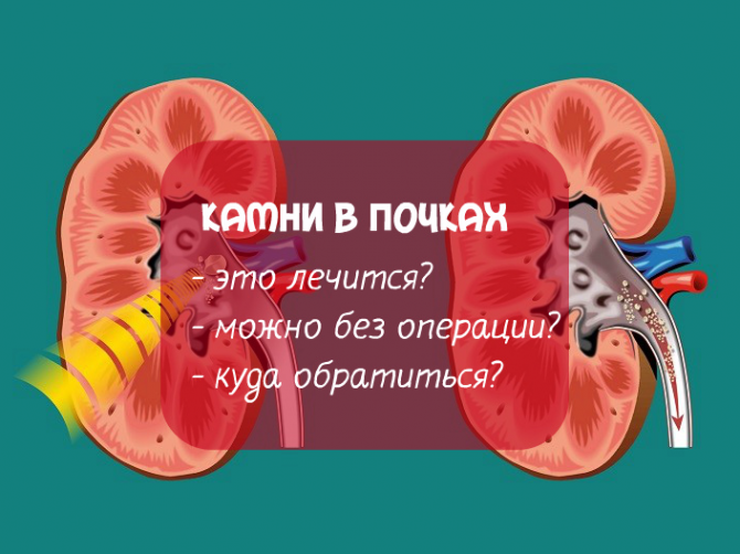 Литотрипсия: виды, преимущества, как проводят, видео операции