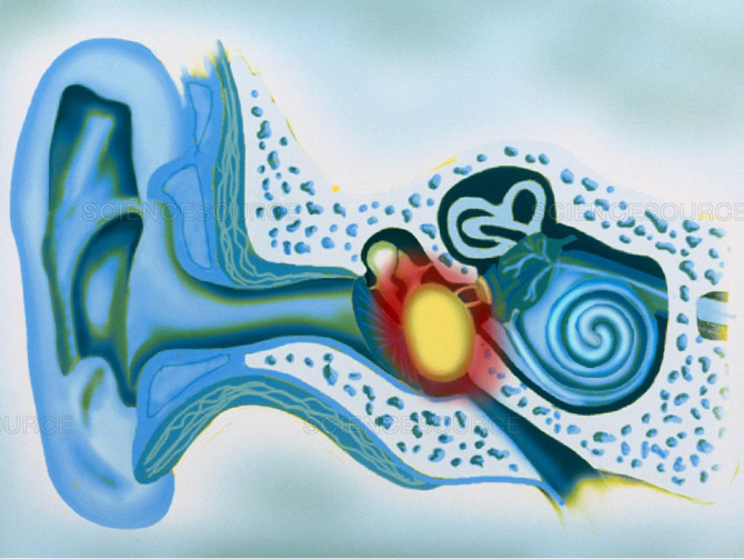 otitis