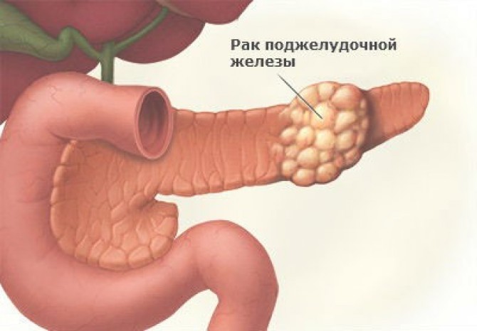 Рак поджелудочной железы – факторы риска