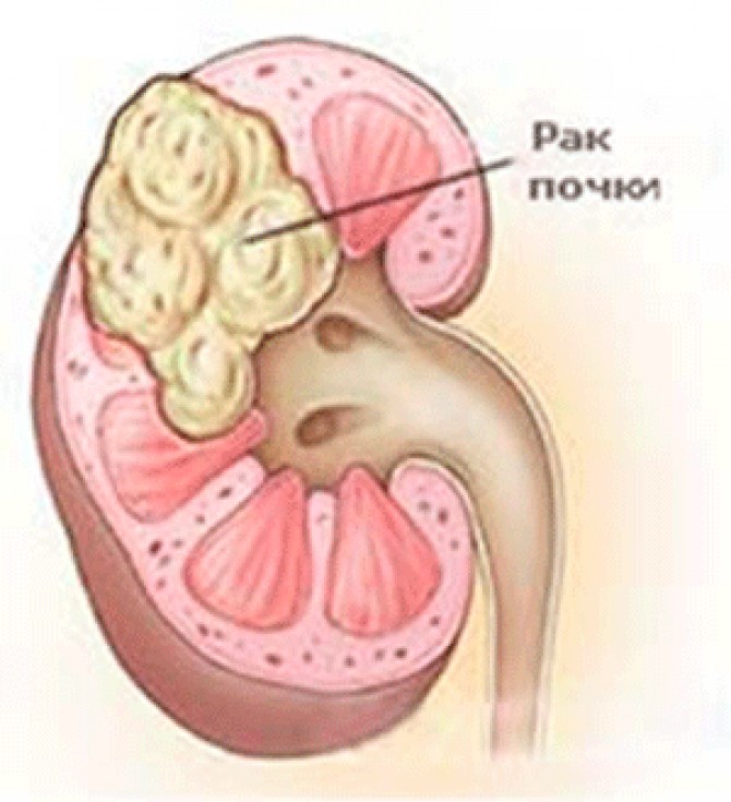 Рак почки: что о нем нужно знать
