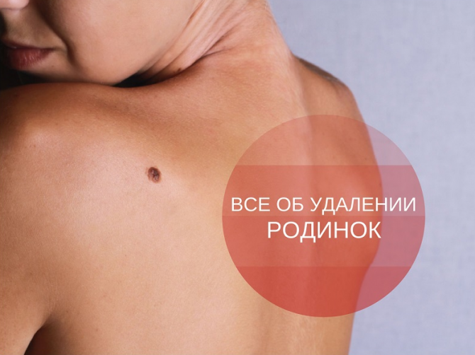 удаление родинок