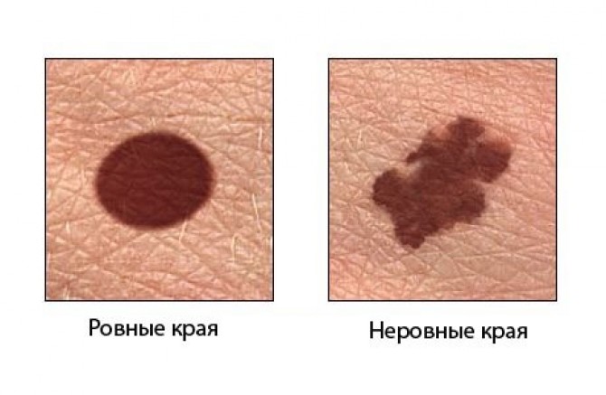 Рецидивирующая меланома : лечение