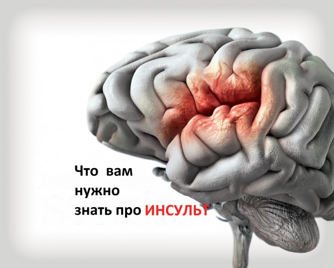 Инсульт головного мозга: 10 фактов, которые вы должны знать + ВИДЕО