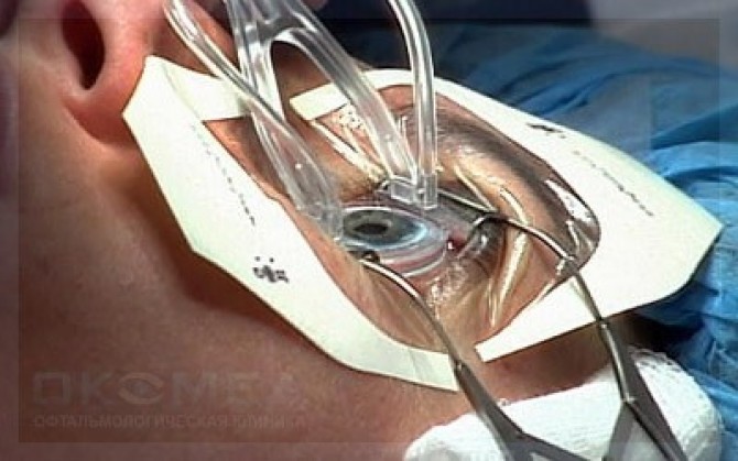 Eye Surgery Lasix Bangkok