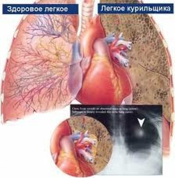 5 фактов о раке легкого – США
