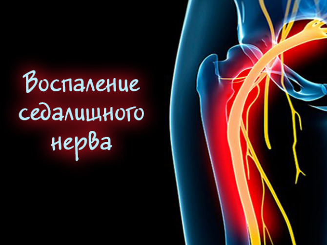 Воспаление седалищного нерва