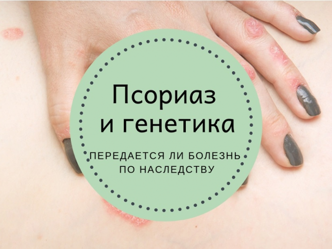 псориаз