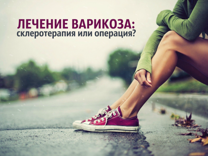 Лечение варикоза: склеротерапия или операция, – врач
