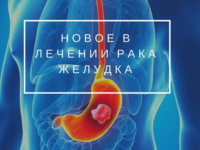 Новый желудок, операция без разрезов и другие новации в борьбе с раком